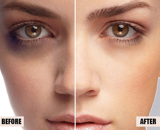 before / after dark circle