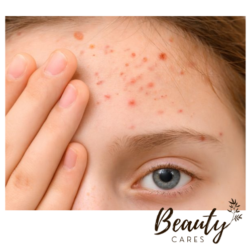 Small pimples on forehead